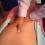 myofascial relese