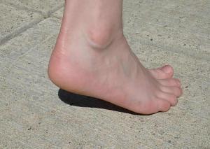 overpronated feet
